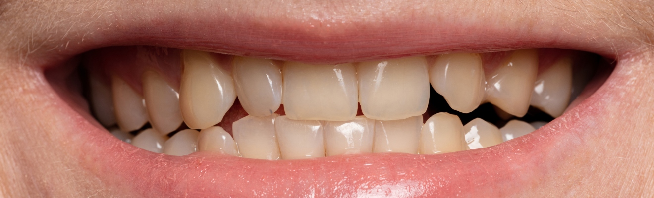 Paciente con dientes amarillos y manchas en el esmalte antes de iniciar su tratamiento de blanqueamiento dental profesional en la clínica Dr. Dhenti.