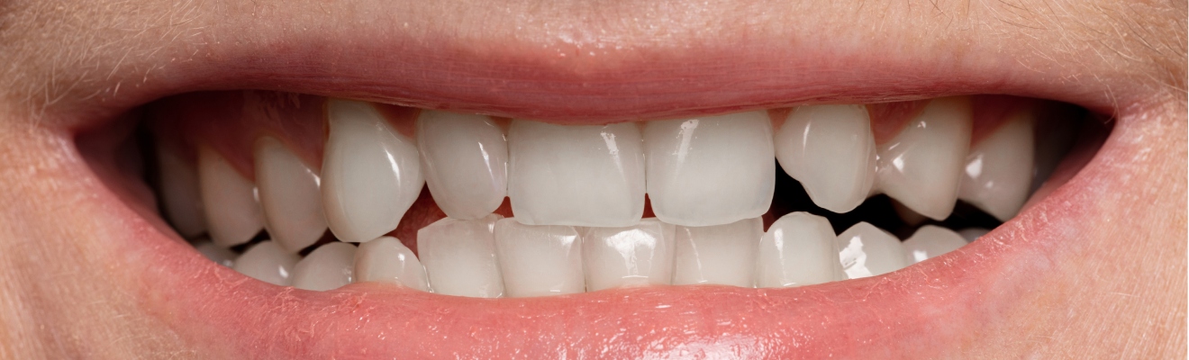 Sonrisa con dientes blancos, brillantes y saludables después de un tratamiento de estética dental rápido y seguro en la clínica Dr. Dhenti, Lima.