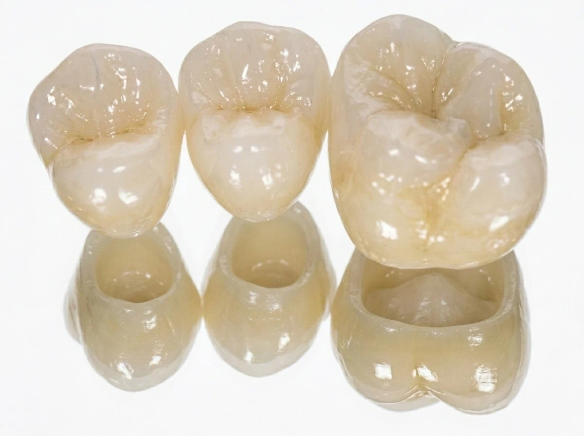 Primer plano de coronas dentales estéticas 100% libres de metal, mostrando su interior blanco para garantizar resultados naturales y premium en la clínica Dr. Dhenti en Lima.