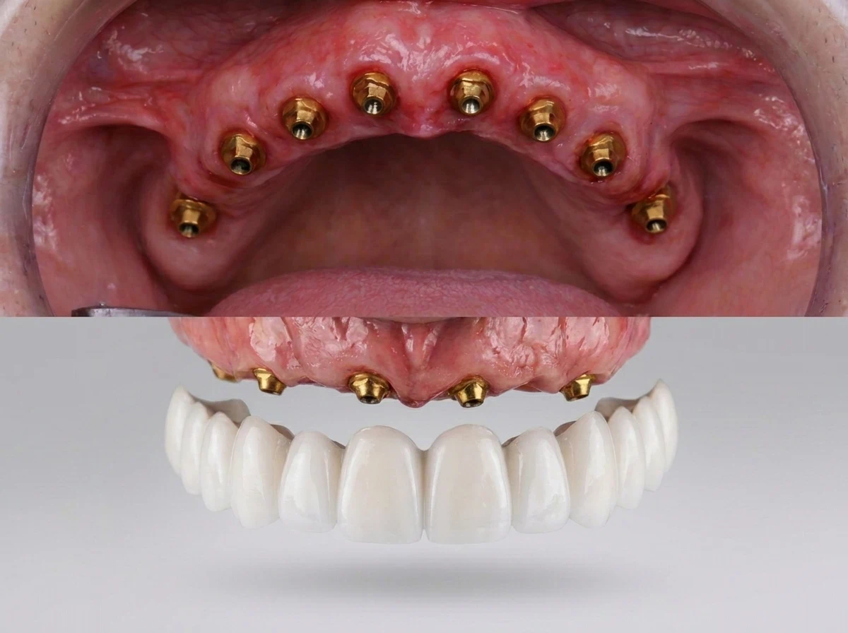 Fotografía clínica de una rehabilitación oral completa sobre implantes, mostrando la prótesis fija definitiva lista para ser colocada en la clínica odontológica Dr. Dhenti en Lima.