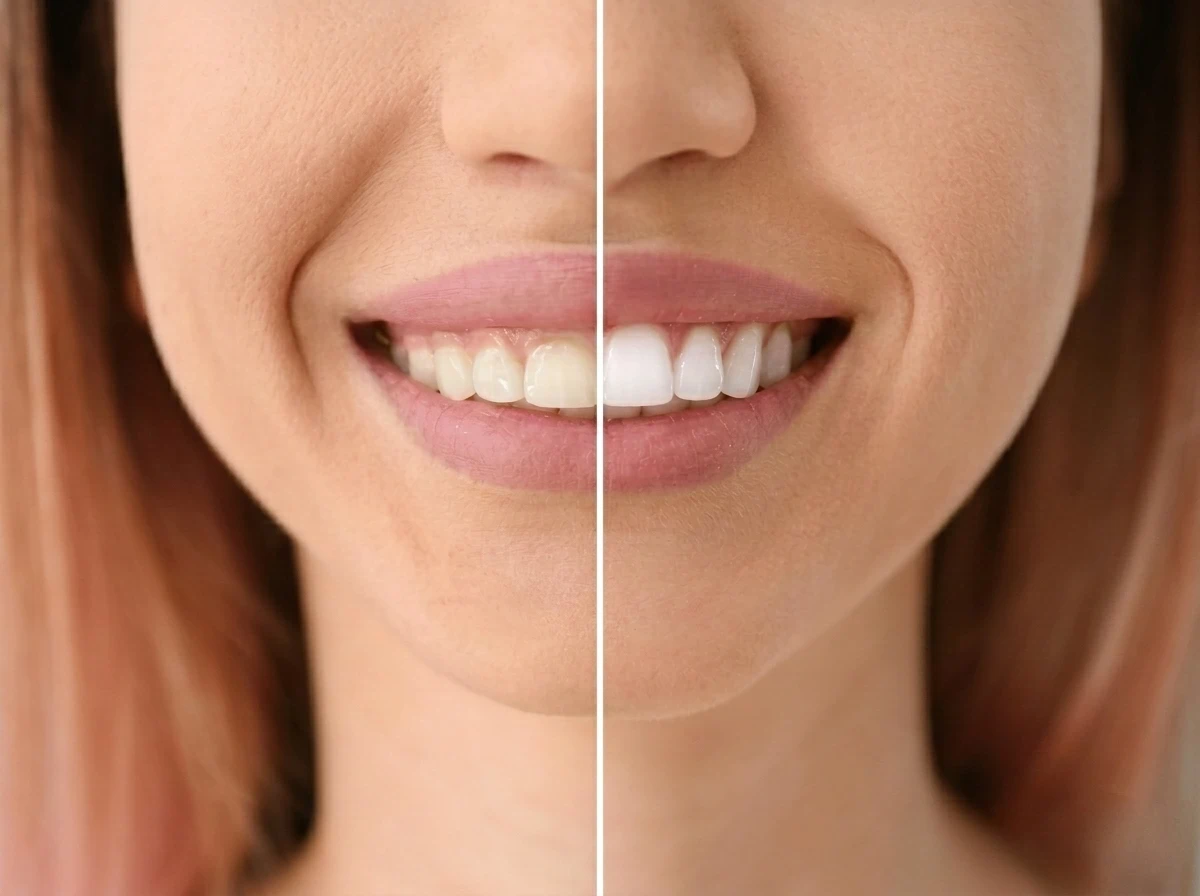 Comparación del antes y después de una gingivoplastia, mostrando el contorneado de encías para alargar visualmente los dientes y lograr una sonrisa simétrica en la clínica Dr. Dhenti en Lima.