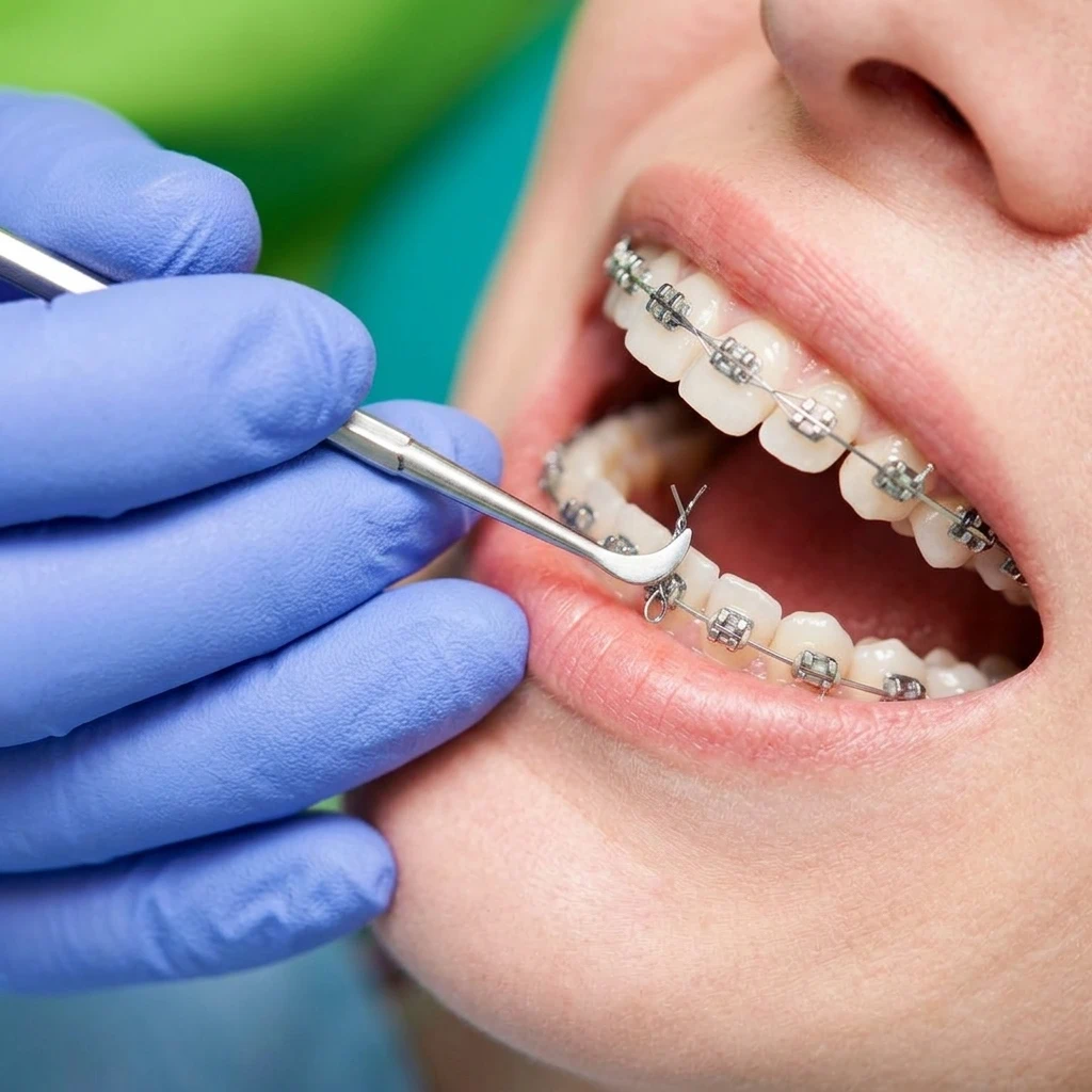 Primer plano detallado de un tratamiento de ortodoncia con brackets metálicos y ligas turquesas en la clínica Dr. Dhenti en San Miguel.